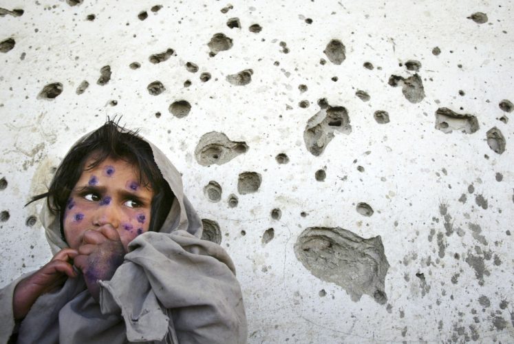 Mahboba, age 7, stands against a bullet-ridden wall waiting to be seen at a health clinic suffering from has a disfiguring skin disease called Leishmaniasis which is a parasitical bacterial infection transmitted from tiny sand fleas.